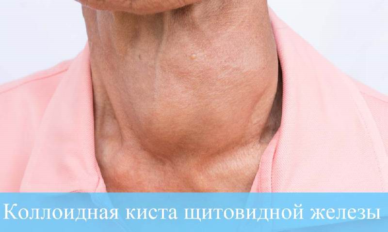 Коллоидная киста щитовидной железы