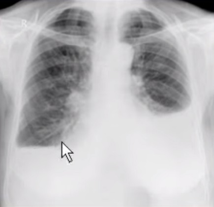 Диагностика пневмоторакса с помощью рентгена