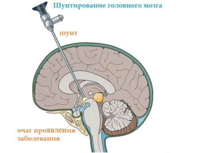 шунтирования мозга
