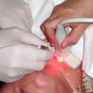  Удаление узлов щитовидной железы лазером 