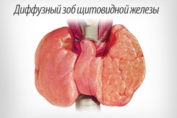 Диффузный зоб щитовидной железы