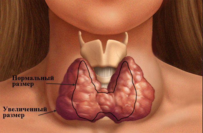 Увеличение щитовидной в размерах