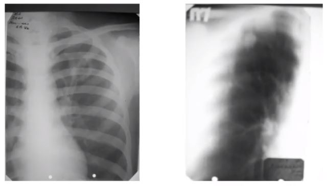 Инфильтративный туберкулез на рентгене