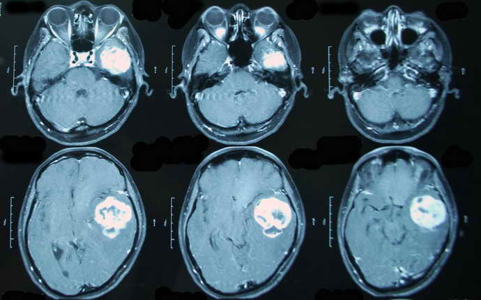 Обследование тканей мозга может проводиться как с окрашенным веществом