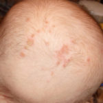 Фото аллергического дерматита на голове у ребенка