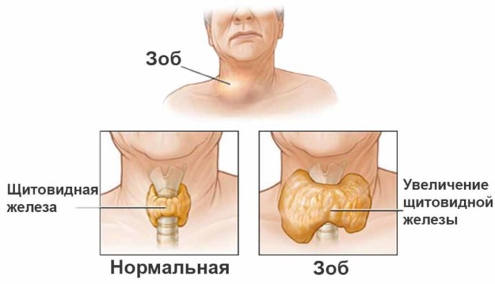 гипертрофия щитовидной железы у ребенка