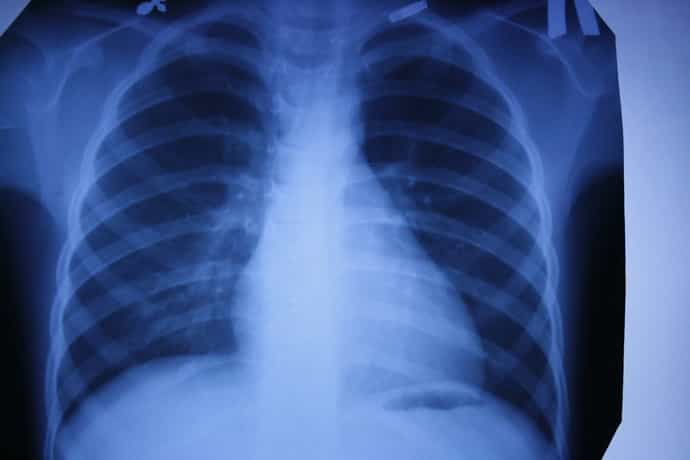 Рентген при онемении пальцев