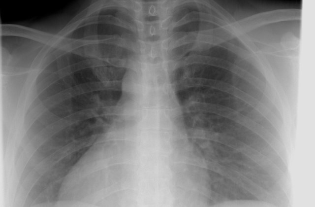 Рентген бесплатный метод диагностики туберкулёза