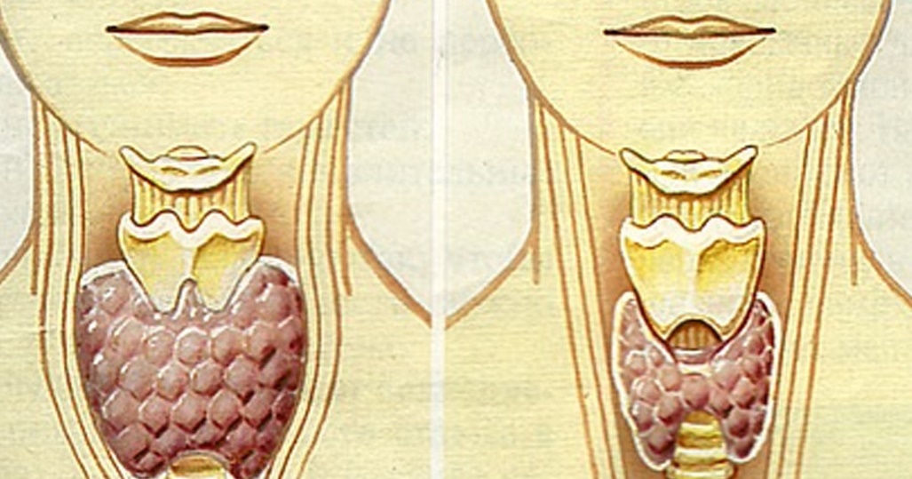 Внешний вид щитовидной железы 