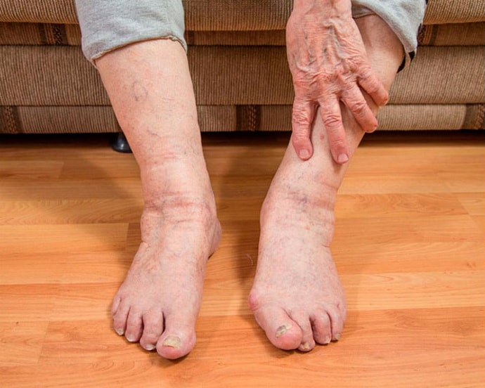 судороги ног и рук у пожилых людей причины лечение