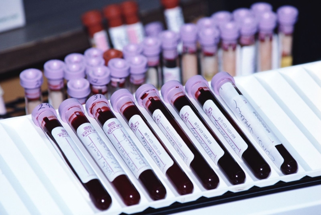 Что такое гемолиз крови? Виды, нормы, причины, признаки и лечение