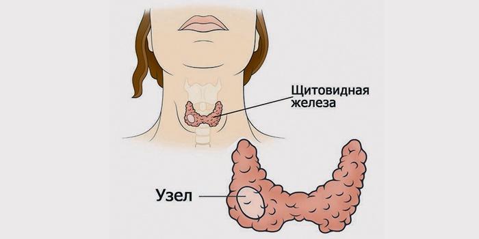 анэхогенное содержимое