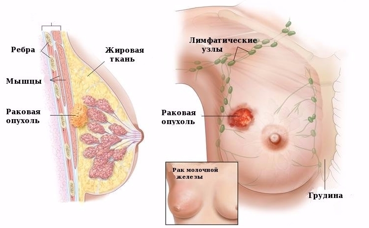 Лимфоузлы на грудине у женщин