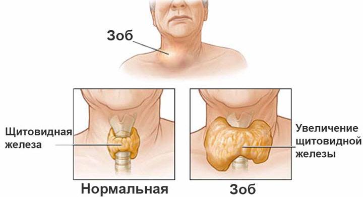 Зоб щитовидной железы симптомы и лечение народными средствами
