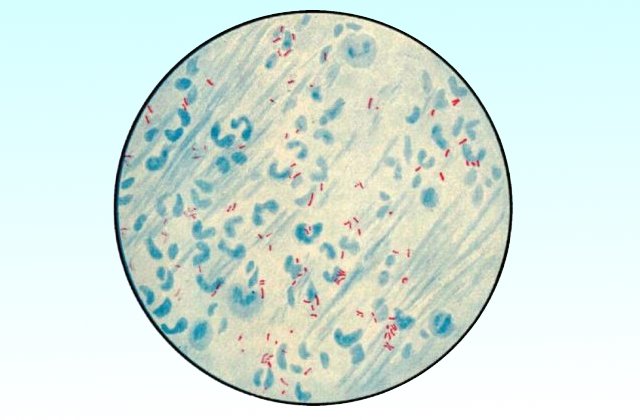 Окраска по Циль-Нильсену микобактерий туберкулеза