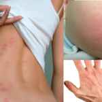 Причины возникновения дерматита, первые симптомы