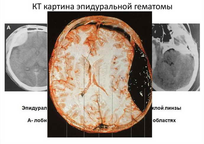 гематома головного мозга признаки