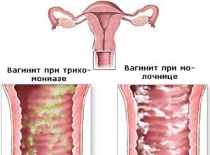 Причины появления молочницы у женщин и эффективные методы её лечения