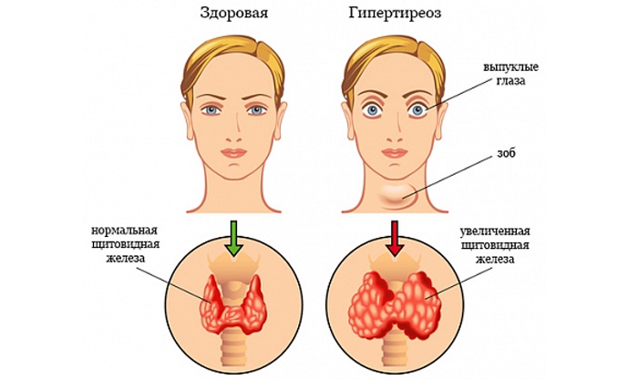 Симптомы гипертиреоза