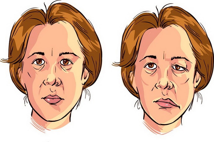 Застужен лицевой нерв: причины и симптомы заболевания