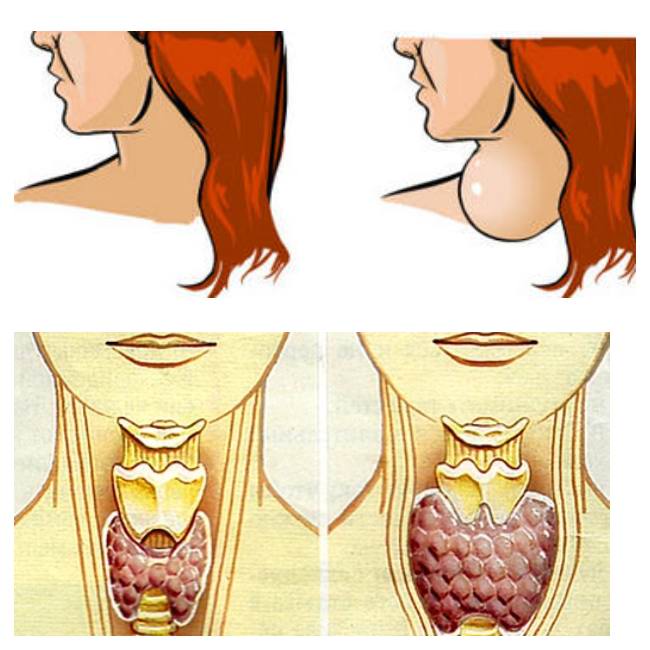 Узлы щитовидной железы симптомы и лечение