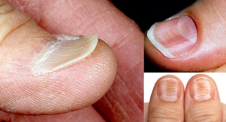Ломкость ногтей от железодефицита