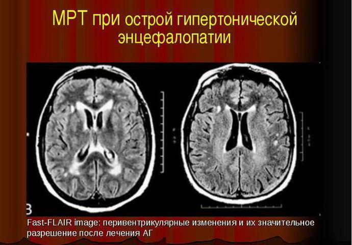 Рассеянный склероз и другие заболевания мозга на МРТ