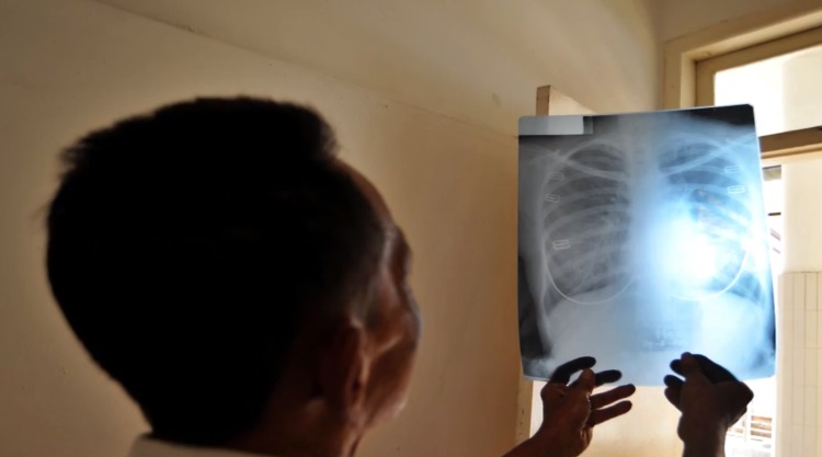 Профилактика туберкулеза рентген, флюорография