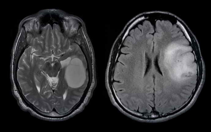олигодендроглиома головного мозга
