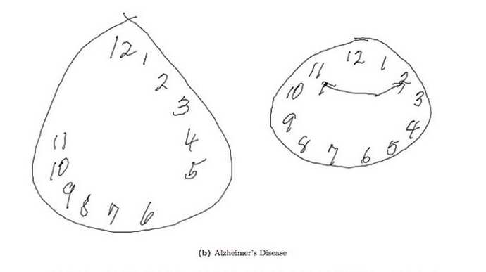 Тесты с рисованием на альцгеймера
