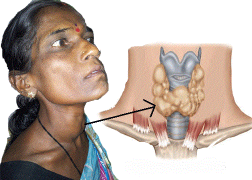 многоузловая щитовидная железа