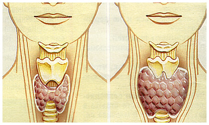 щитовидная железа