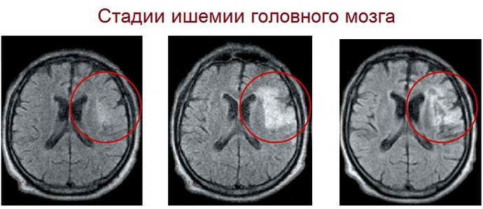 ишемия головного мозга у новорожденного стадии