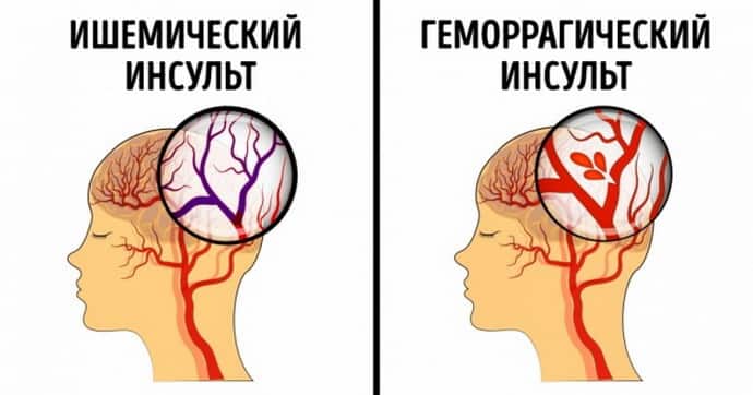 Причины возникновения акустико мнестическая афазии