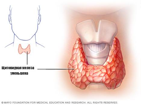 Щитовидная железа уменьшена