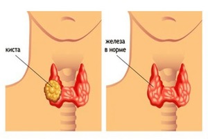 киста щитовидной железы