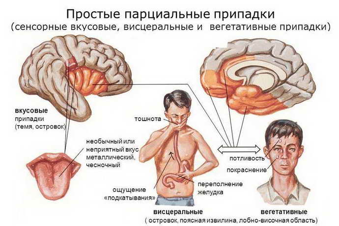Как определить эпилептический припадок