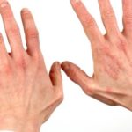 Фото дерматита на коже рук