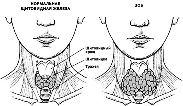 гипертрофия узловые изменения щитовидной железы