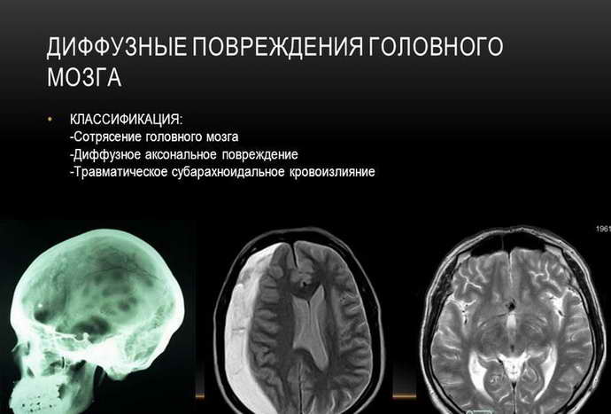 диффузное аксональное повреждение головного мозга виды
