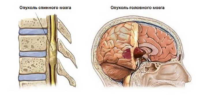 менингиома головного мозга