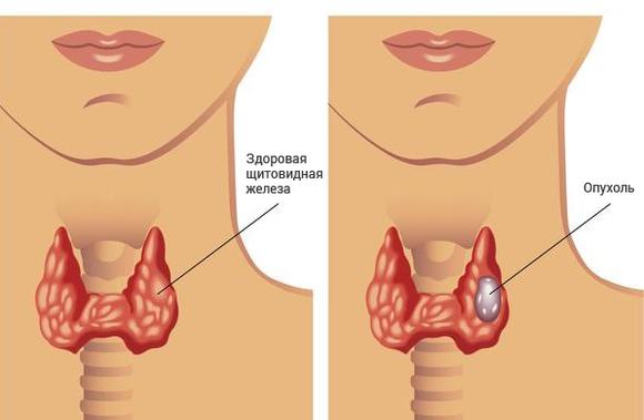 образование левой доли щитовидной железы