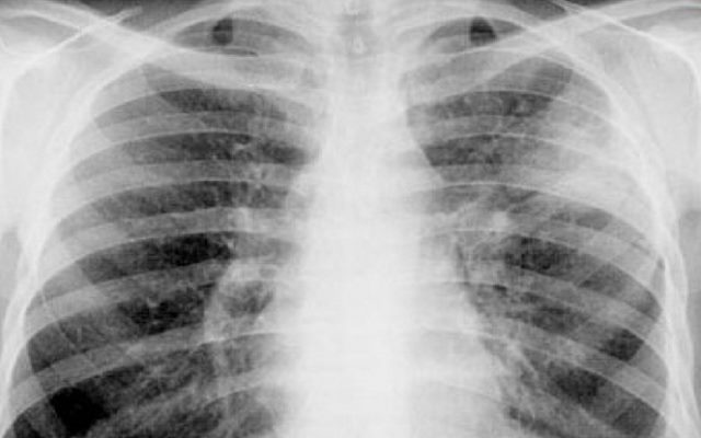 Инфильтративный туберкулёз левой и правой части лёгкого грудной клетки