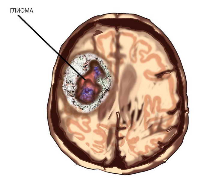 Глиома головного мозга