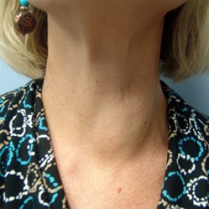 Рост узлов щитовидной железы 