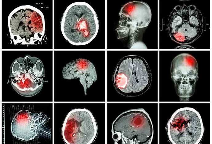 КТ головного мозга помогает получить различную информацию 