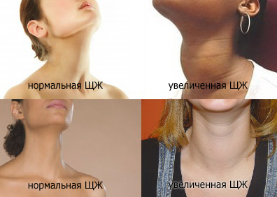 нормальная и увеличенная щитовидная железа