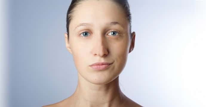 Симптомы пареза лицевого нерва