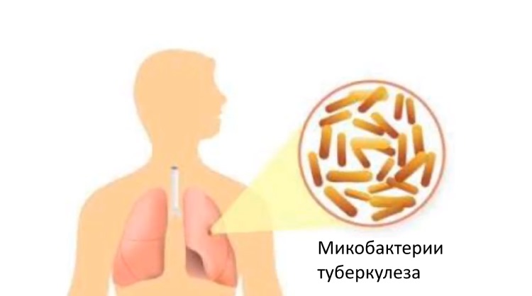 Причины заболевания туберкулезом