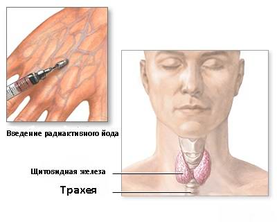 радиоизотопное исследование щитовидной железы